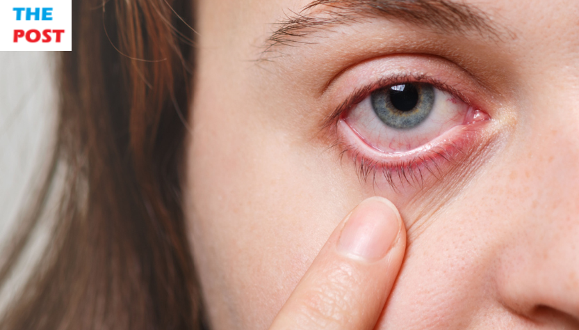 Understanding Blepharitis: Recognizing Symptoms, Exploring Causes, Diagnosis, Treatment, and Prevention Methods